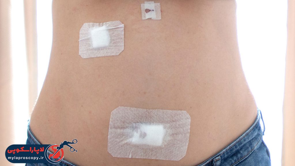 جراحی لاپاراسکوپی کیسه صفرا در شیراز
