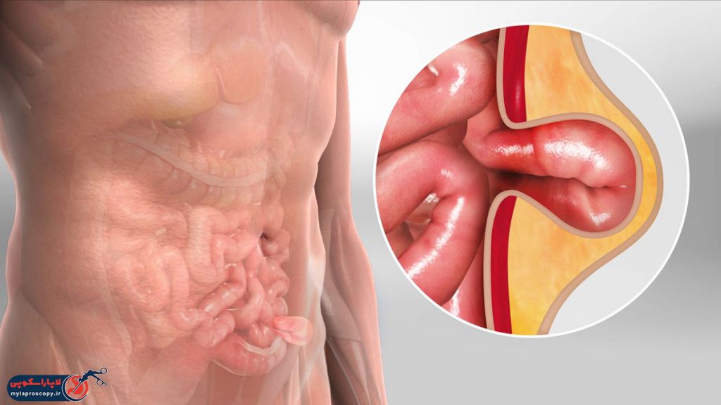 بهترین دکتر متخصص فتق در شیراز