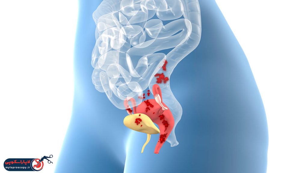 لاپاراسکوپی آندومتریوز در شیراز