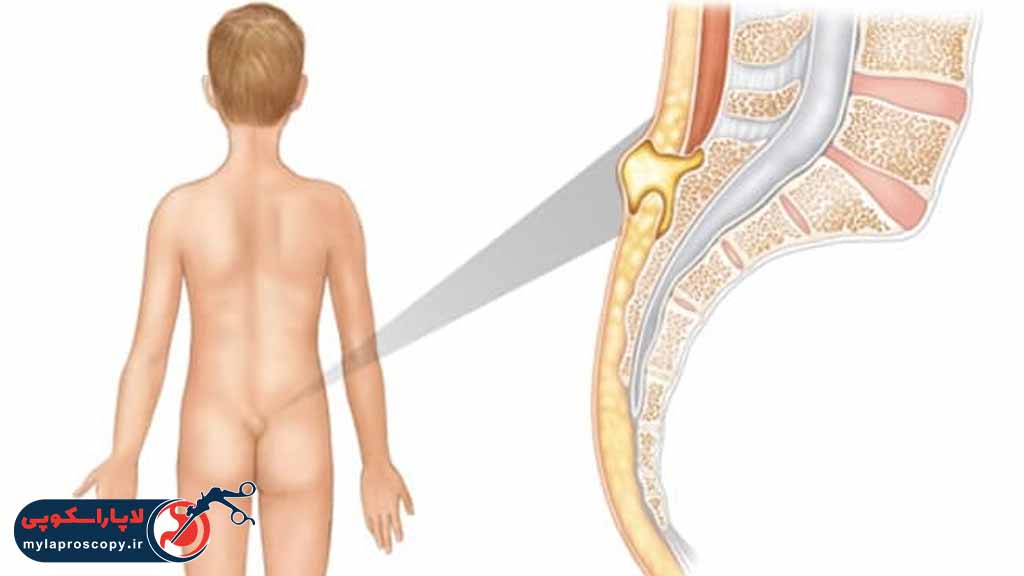 هزینه جراحی کیست مویی در شیراز چقدر است؟