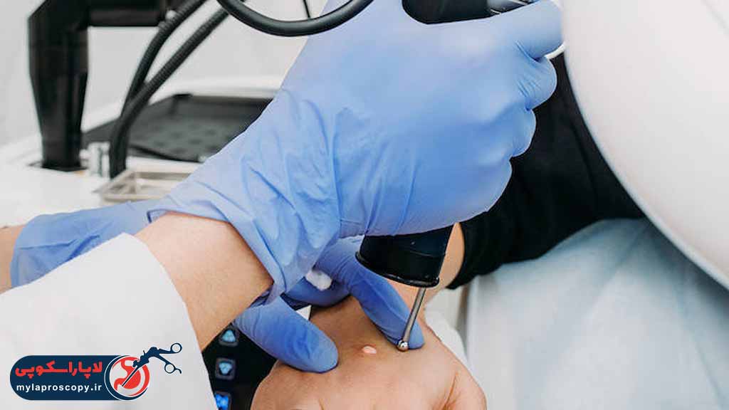 هزینه کرایوتراپی در شیراز چقدر است؟