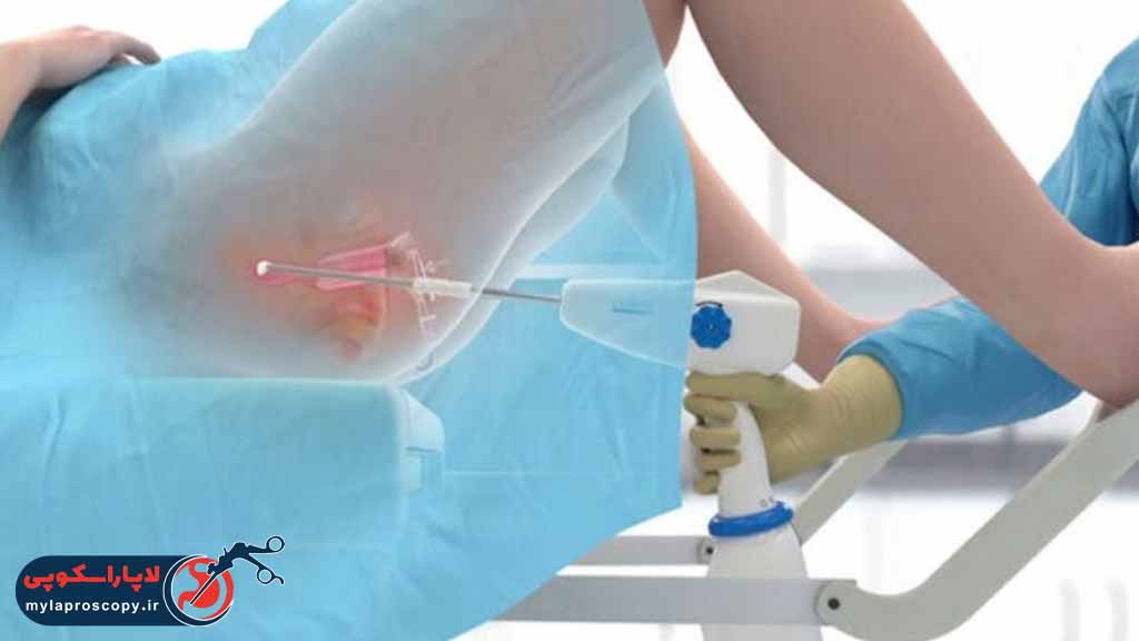 لیزر واژینال چیست؟