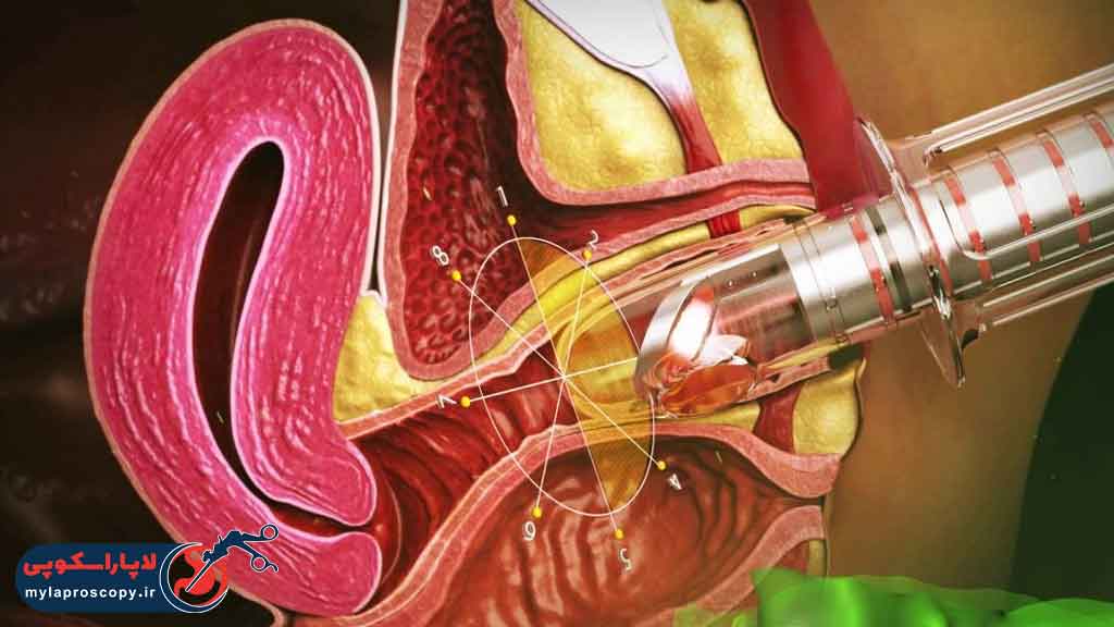 هزینه لیزر واژینال در شیراز چقدر است؟