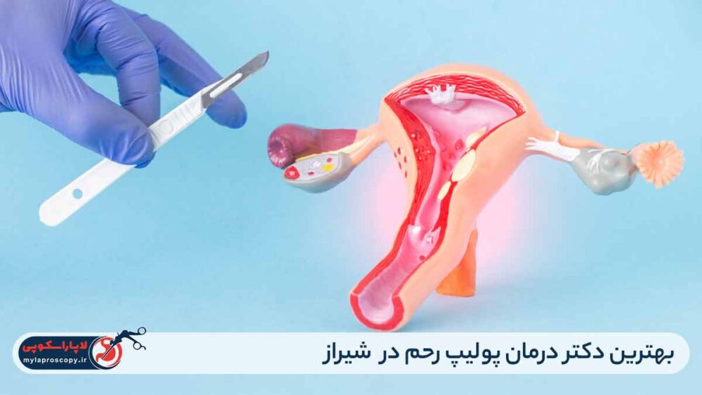 بهترین دکتر درمان پولیپ رحم در شیراز